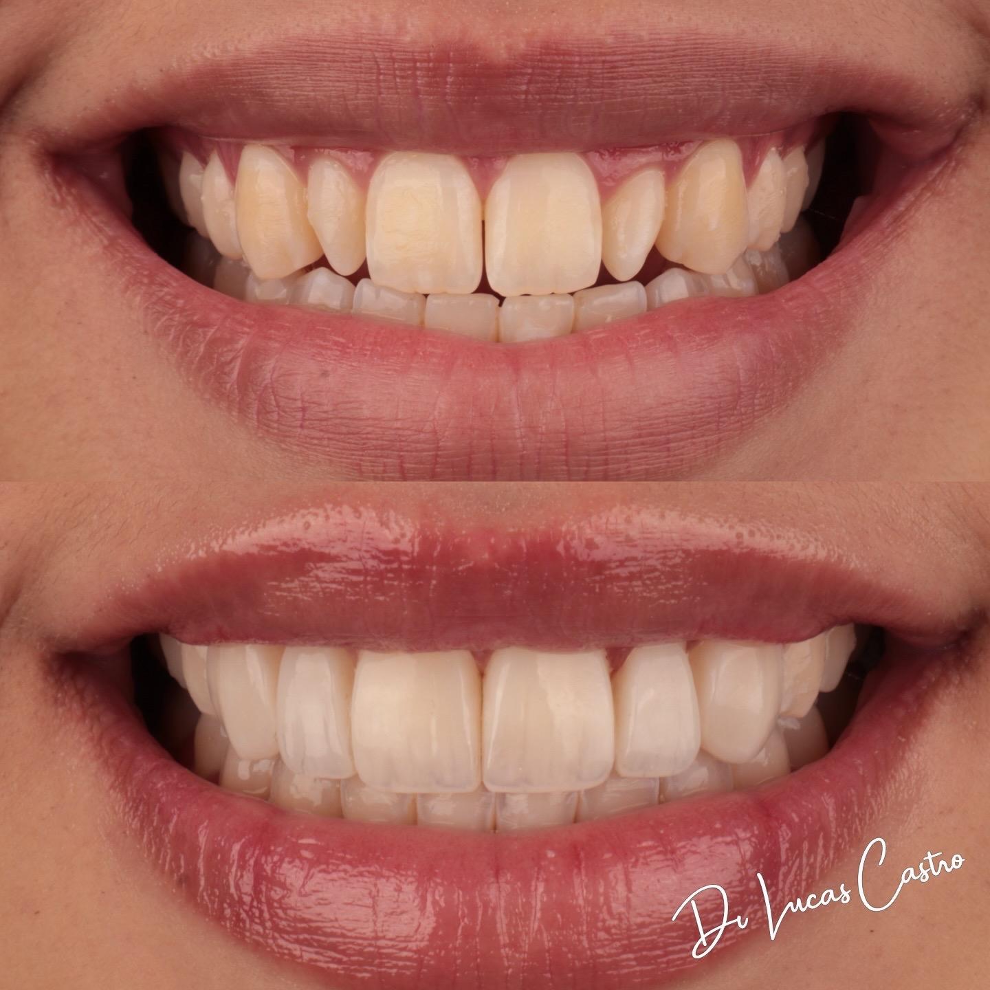 Antes e depois de clareamento dental