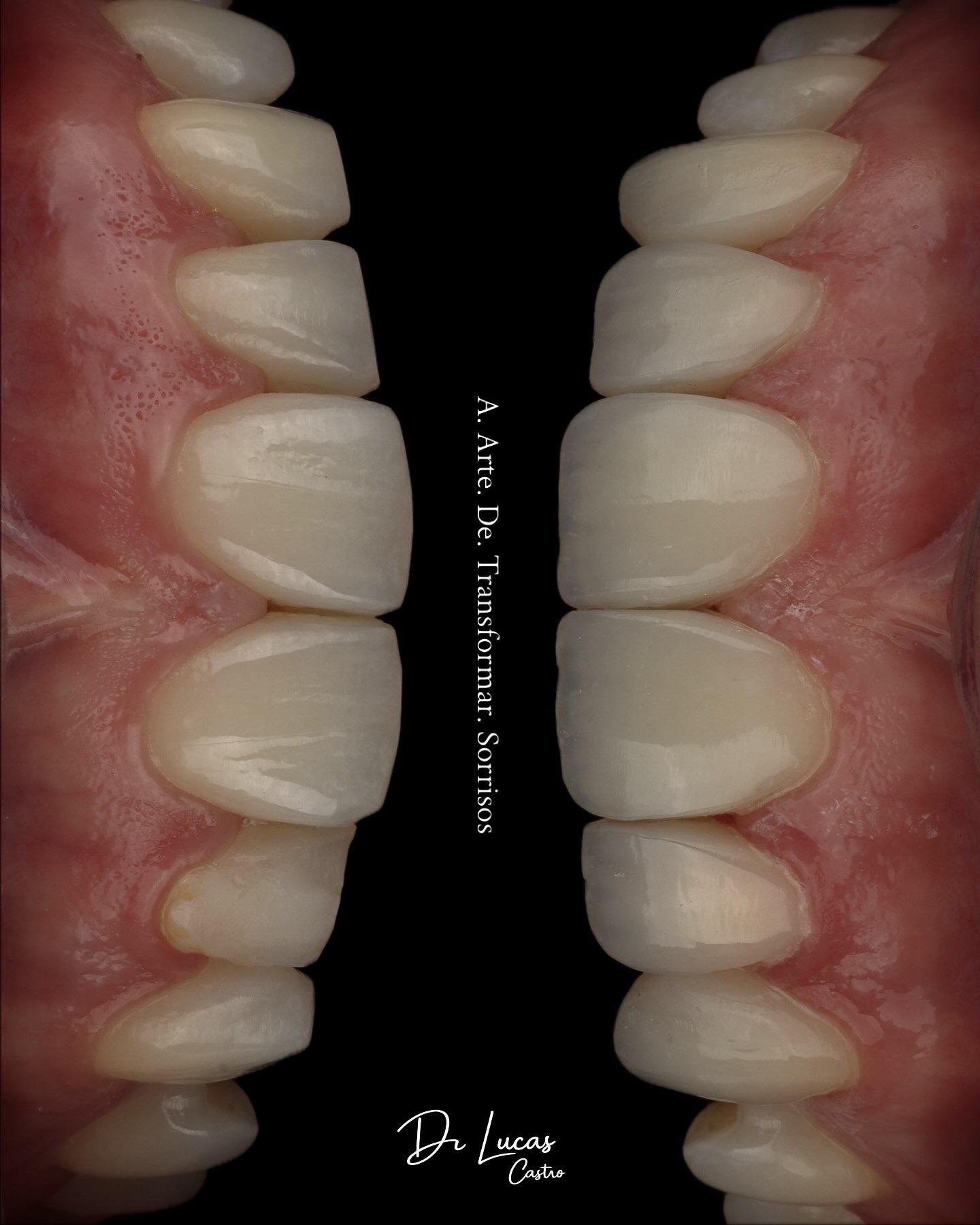 Detalhe lateral de um sorriso após tratamento estético