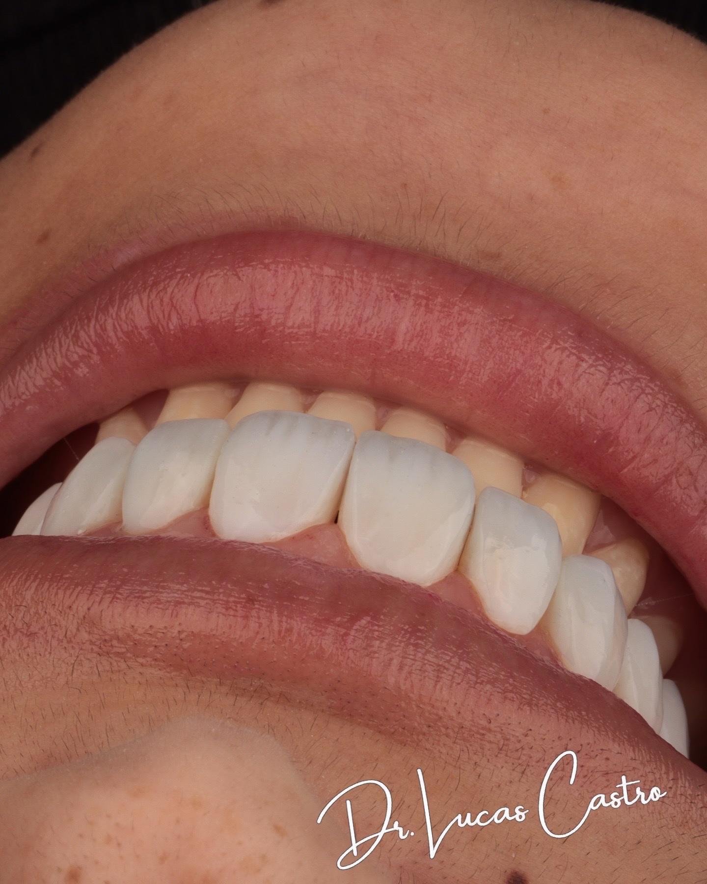 Detalhe lateral de sorriso com resultado natural